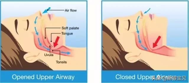 宝宝嗓子呼噜有痰小妙招,宝宝嗓子呼噜呼噜响是怎么回事