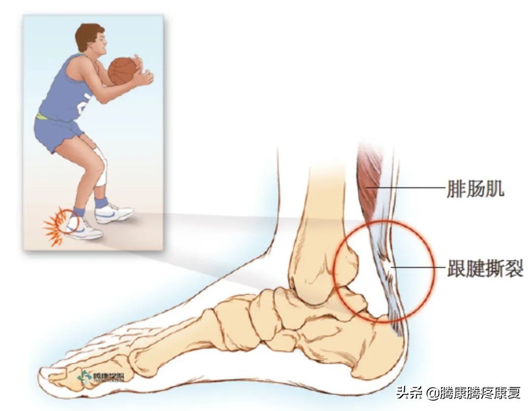 跟腱炎临床诊疗指南,跟腱炎起因和治疗