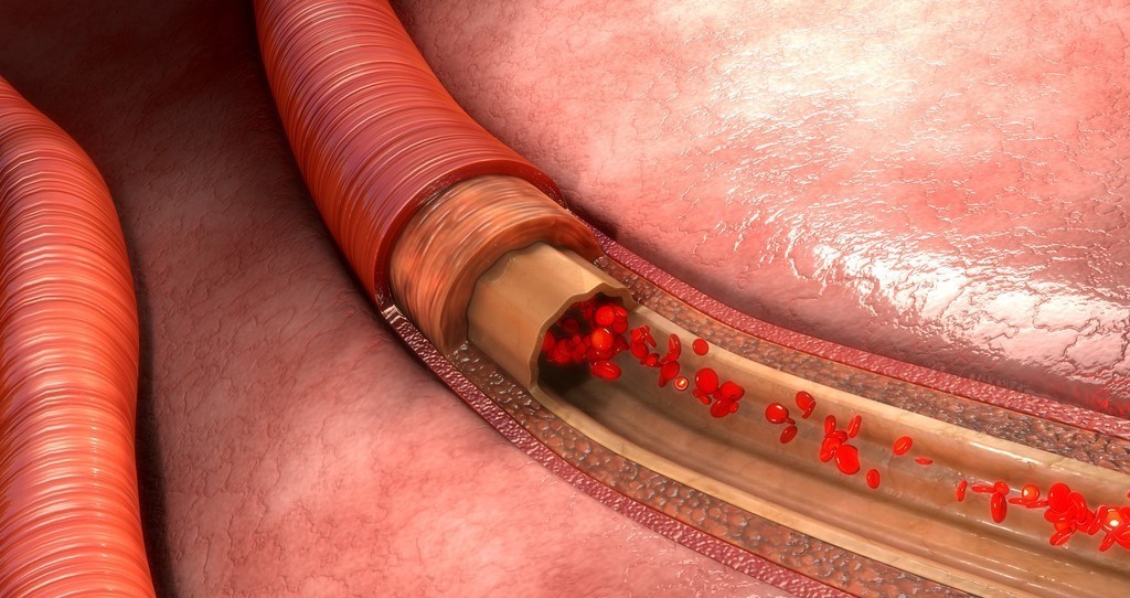有颈动脉斑块能长期吃他汀类药吗,颈动脉有斑块需要长期吃他汀药吗