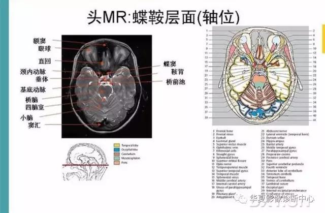 mra头颅解剖学详细讲解视频,常见的头颅mri图像