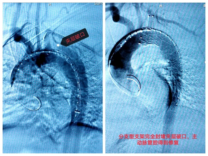 男子腹痛手术,苏州九龙医院做阑尾炎手术