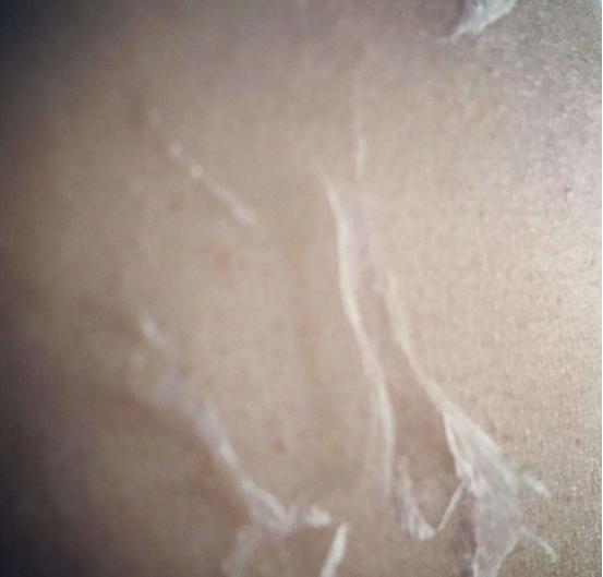 军训晒伤如何快速修复,军训中晒伤了怎么补救