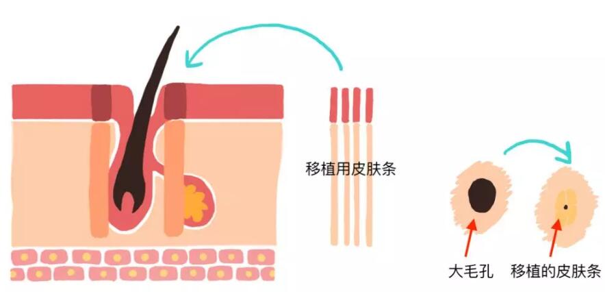 男士如何缩小脸部毛孔,脸部去黑头螨虫缩小毛孔