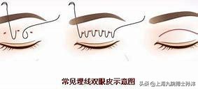 做了埋线为什么感觉睁不开眼睛,之前是埋线再做全切有影响吗