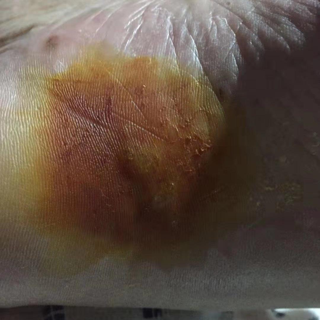 生殖器疱疹会误诊为带状疱疹吗,带状疱疹引起腰痛误诊分析