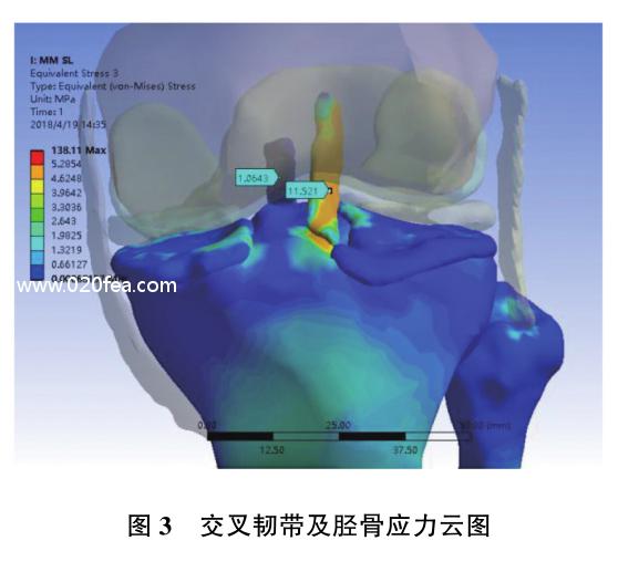 半月板后角二度真实模型,内侧半月板后角结构图