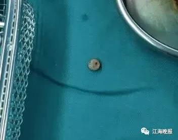 2岁女童误吞纽扣电池,4岁女童吞下纽扣电池