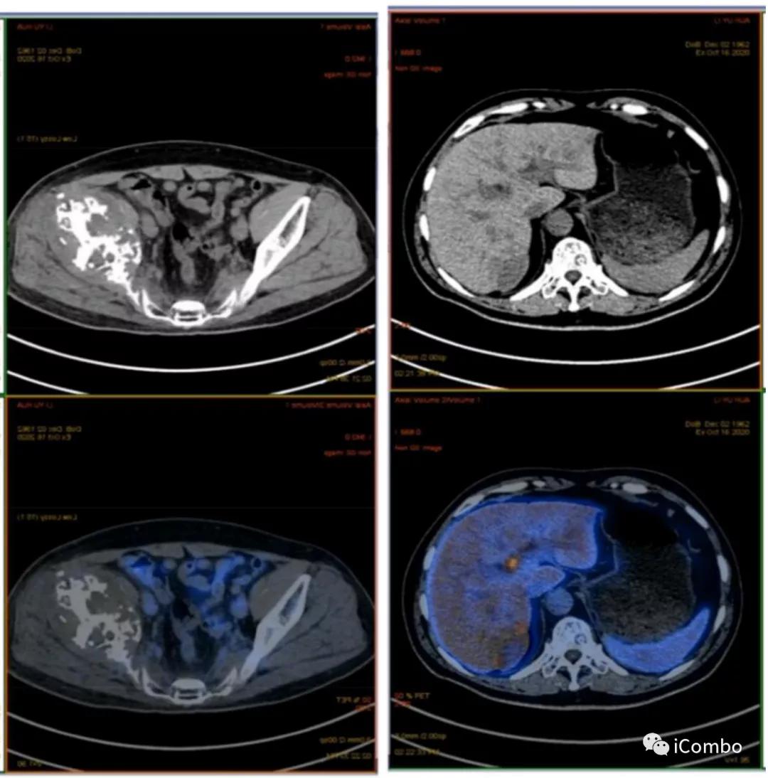 肾癌369例临床分析,恶性肾癌中晚期治疗方案