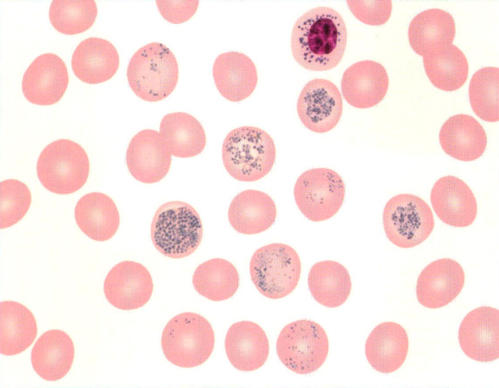 突然贫血最明显的5个征兆,突然贫血头晕身体发冷怎么回事