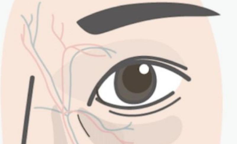 如何改善黑眼圈最有效,黑眼圈是怎么形成的如何淡化