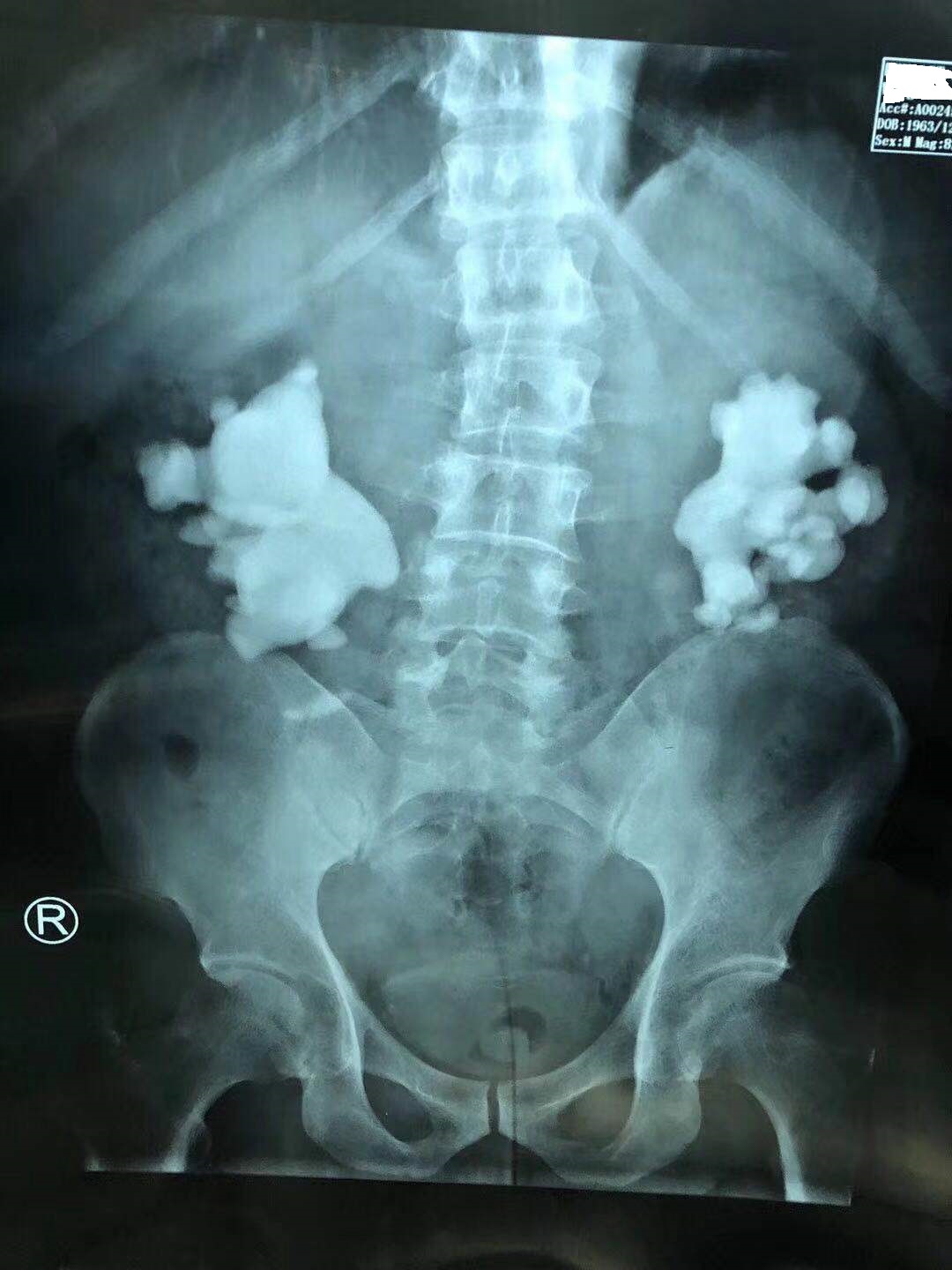 鹿角型结石最严重的后果,疯狂的石头肾脏