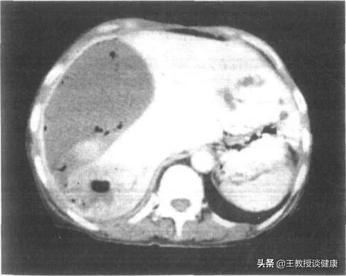 肛周脓肿是不是糖尿病引起的,脓肿为什么会有硬结