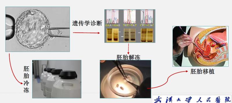 携带遗传致病基因的父母，如何生下健康后代？武汉大学人民医院这个团队给出解决方案