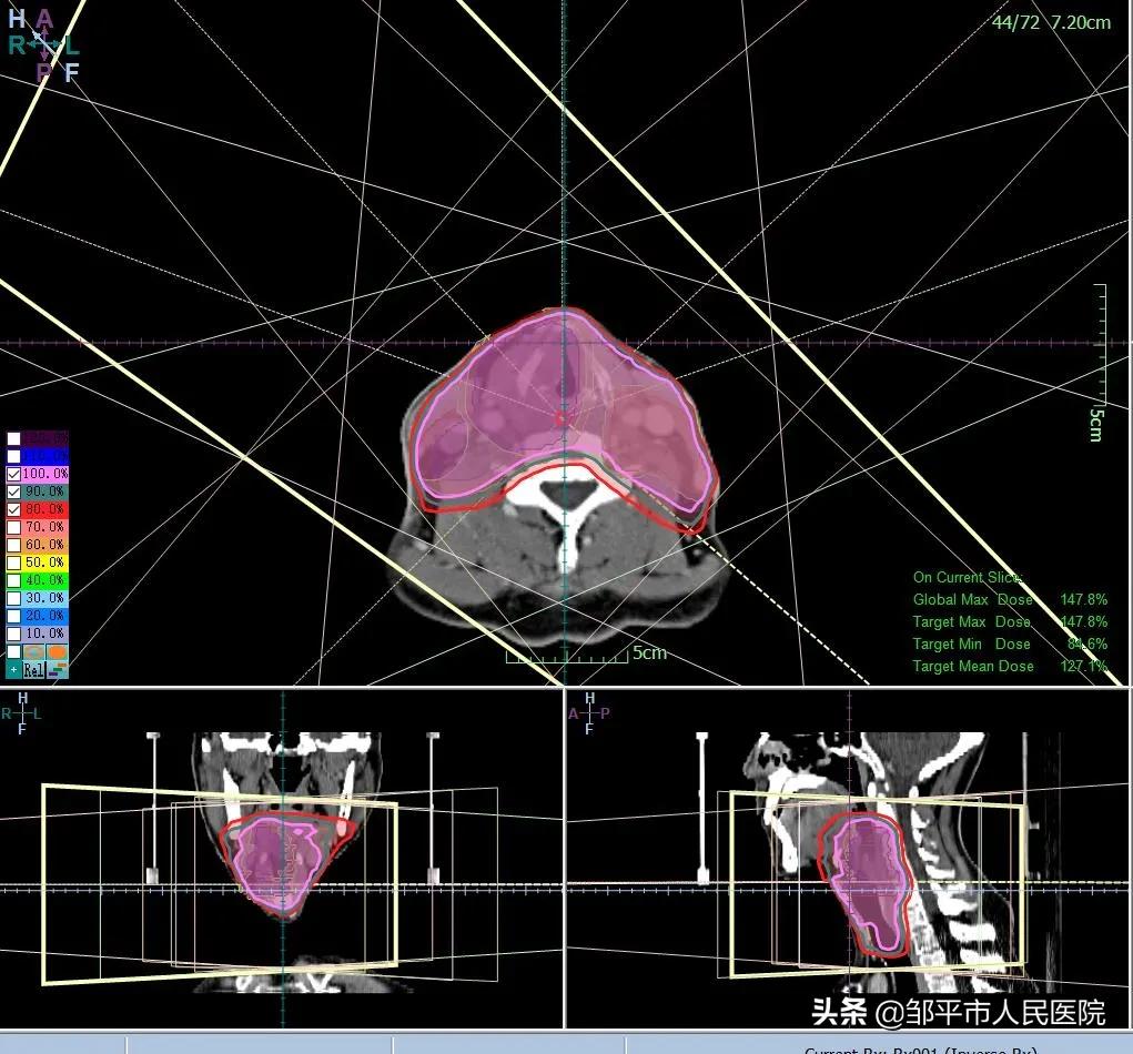 放疗三个疗程35次,三院放疗科
