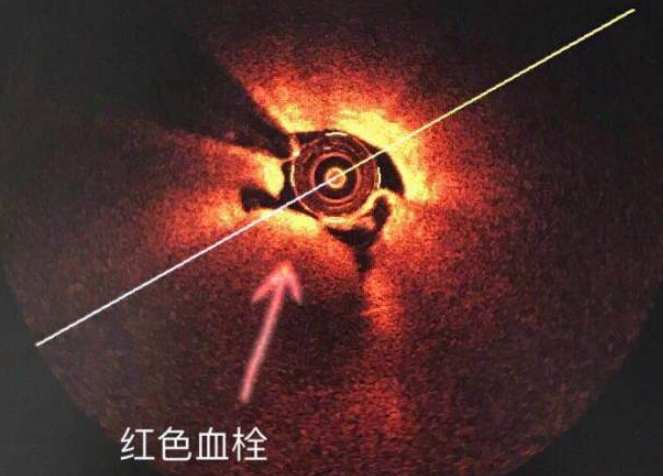 信阳市中心医院心脏射频消融手术,信阳中心医院心血管科室怎样