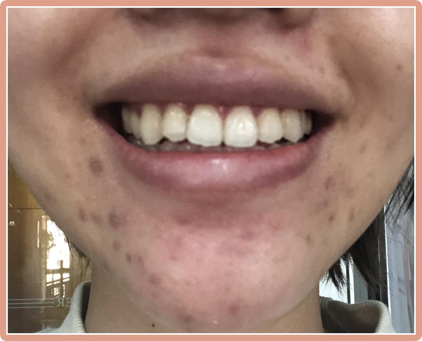 20多年治疗痘痘的经验汇总,10元祛痘印推荐