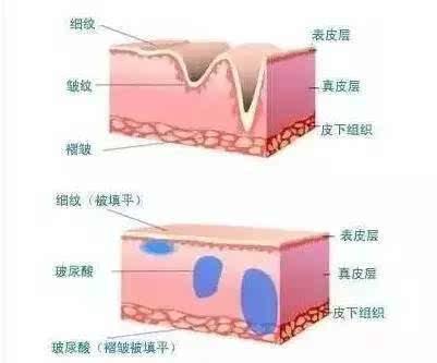 轻松搞定脸上的干纹细纹,脸上干纹细纹比较多怎么办