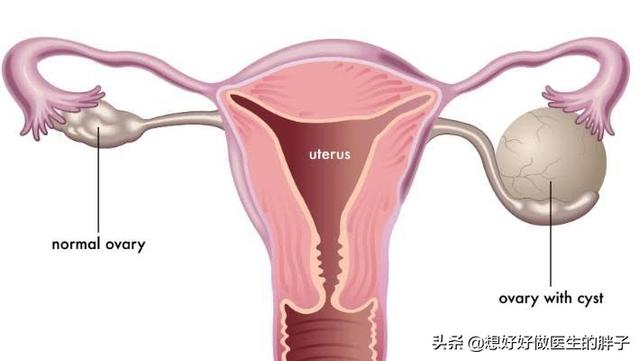 辟谣囊肿手术,得了囊肿必须切除么