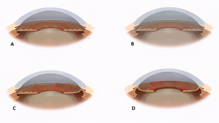 继发性青光眼最佳治疗方法,外伤引起继发性青光眼