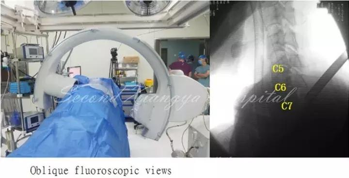 经皮腰椎间盘切除术有何优缺点,什么是经皮内镜腰椎手术