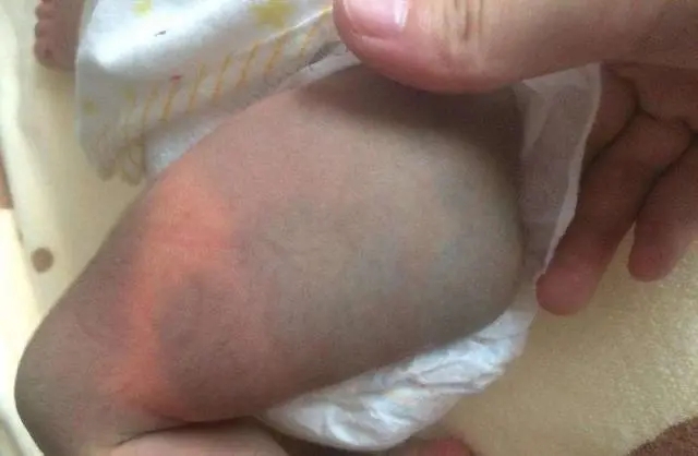 新生儿出生时屁股为啥青,孩子出生为啥屁股一大片淤青