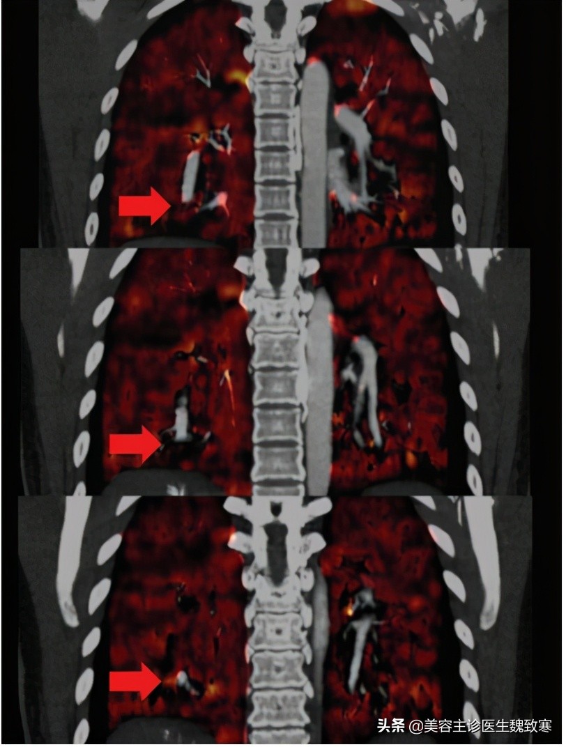 私密整形严重并发症:阴道注射填充剂9小时后永久停止呼吸