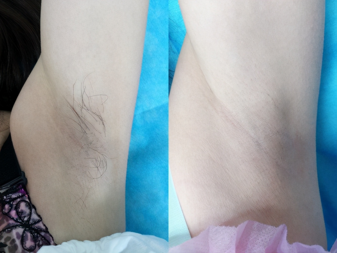 毛发脱毛,哪种脱毛才是永久性脱毛