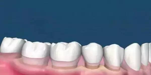 洗牙到底怎么洗好,洗牙洗的不干净