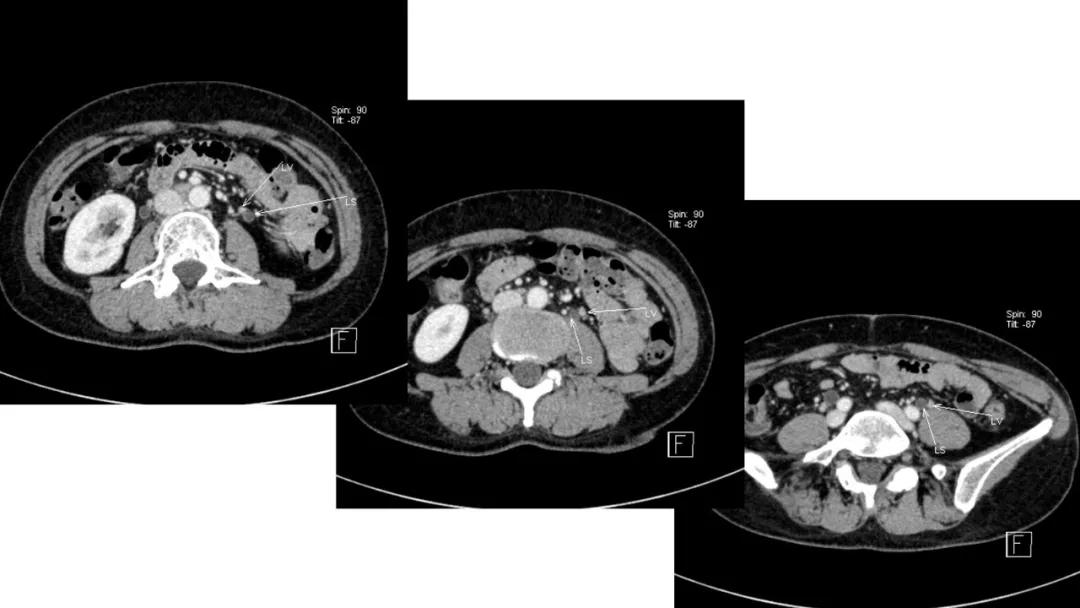卵巢原发肿瘤的分析思路