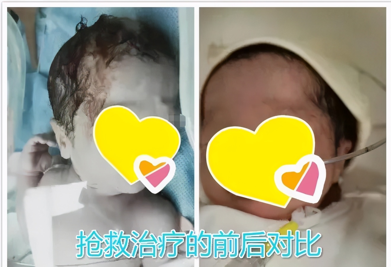 产妇胎心骤降胎儿命悬一线,产妇胎儿宫内窘迫抢救措施