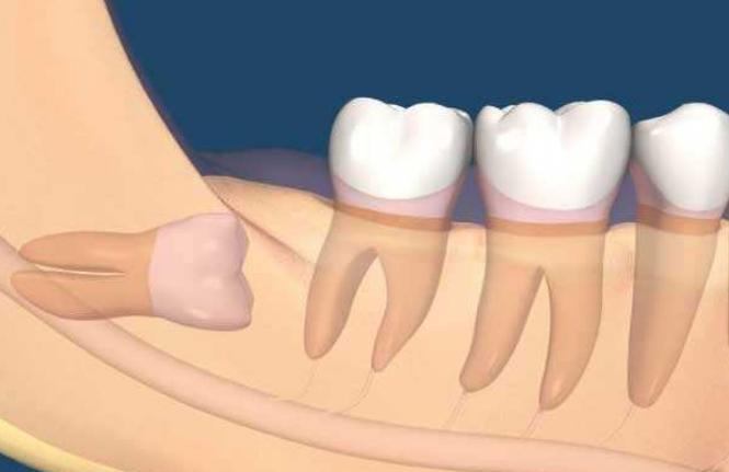 牙医建议拔牙就一定要拔吗,牙医总劝你拔牙