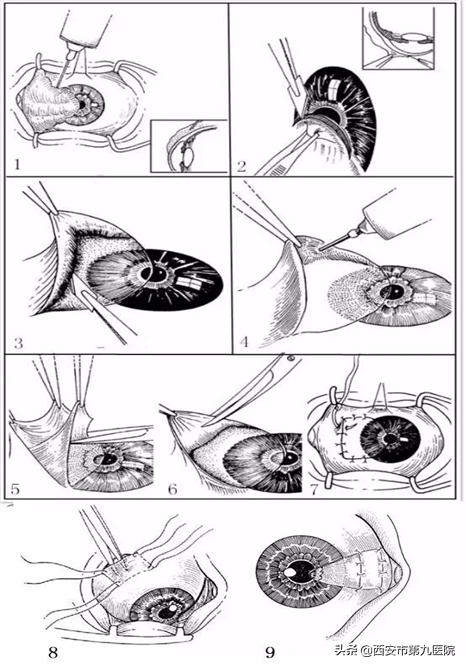 眼睛里长肉,眼睛翼状胬肉需要治疗吗
