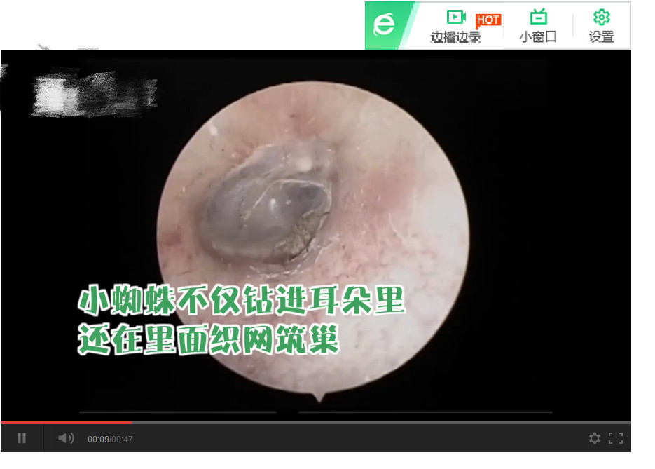 男子检查耳朵发现活蜘蛛,男子耳朵奇痒难忍竟是里面长霉了