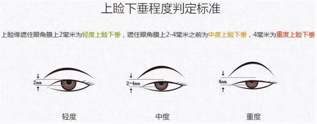 双眼皮宽深修复后三眼皮案例,修复假宽深双眼皮最好的医院