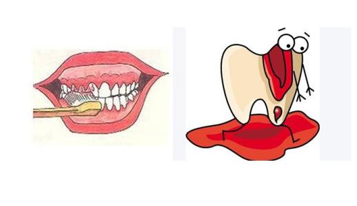 牙龈自发出血是什么原因牙周炎,牙龈出血的危害