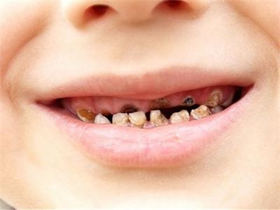 小孩乳牙蛀了做根管有必要吗,小孩子乳牙被蛀空了需要去处理么