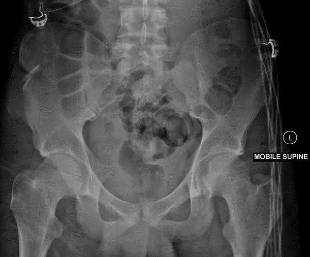 所有骨折都叫什么名字,骨折的名称有哪些