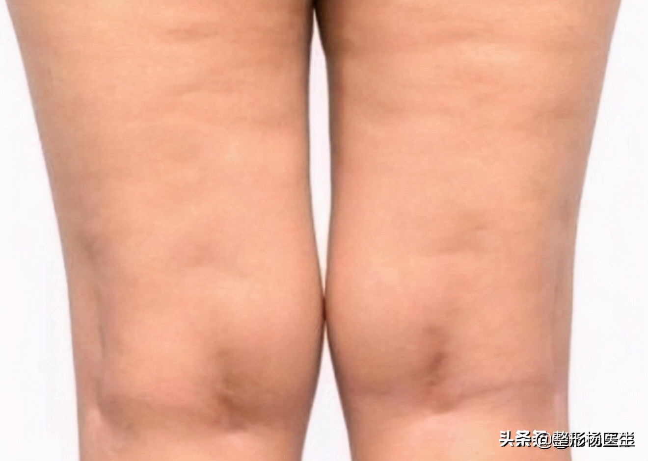 20岁面部凹陷如何改善,脂肪填充面部凹陷怎么导致的呢