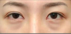 眼袋和卧蚕有什么区别怎么祛眼袋,一招教你怎么判断眼袋还是卧蚕