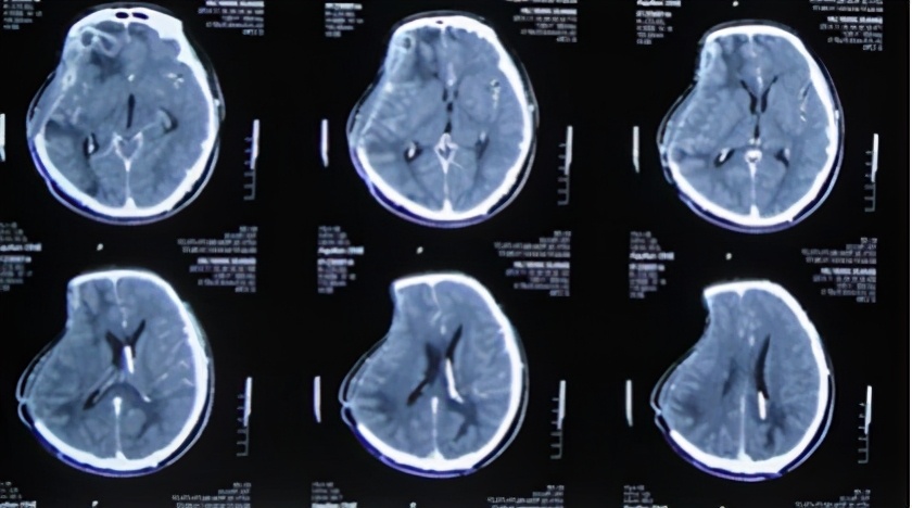 脑外伤开颅手术后脑积水,脑外伤手术后脑脊液鼻漏怎么治疗