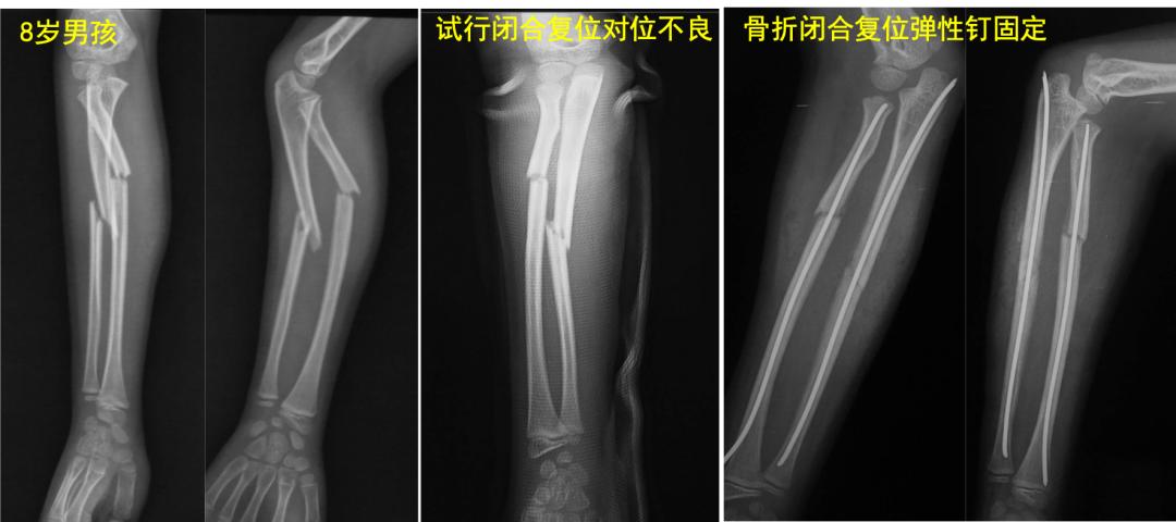 两个儿童前臂骨折争议病例之——元芳你怎么看
