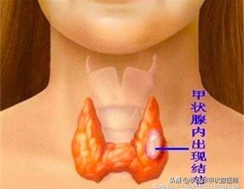 桥本甲状腺炎看中医好还是西医好,甲状腺结节最佳中医治疗方法