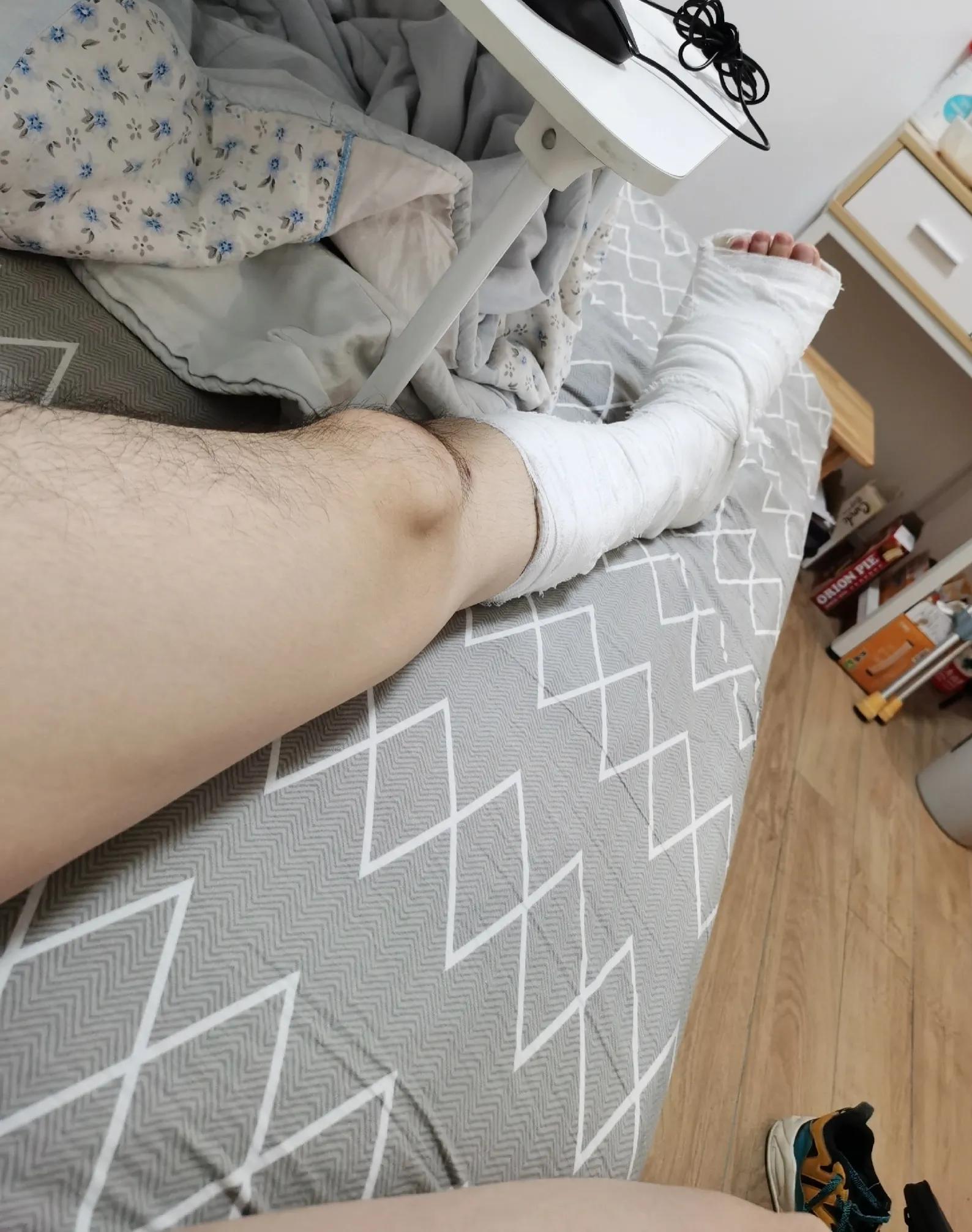 第五跖骨粉碎性骨折多久后能走路,第五跖骨基底骨折100天了走路肿