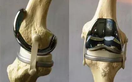 关于膝关节疼痛你一定有好多疑问,关于膝盖疼痛的疑问