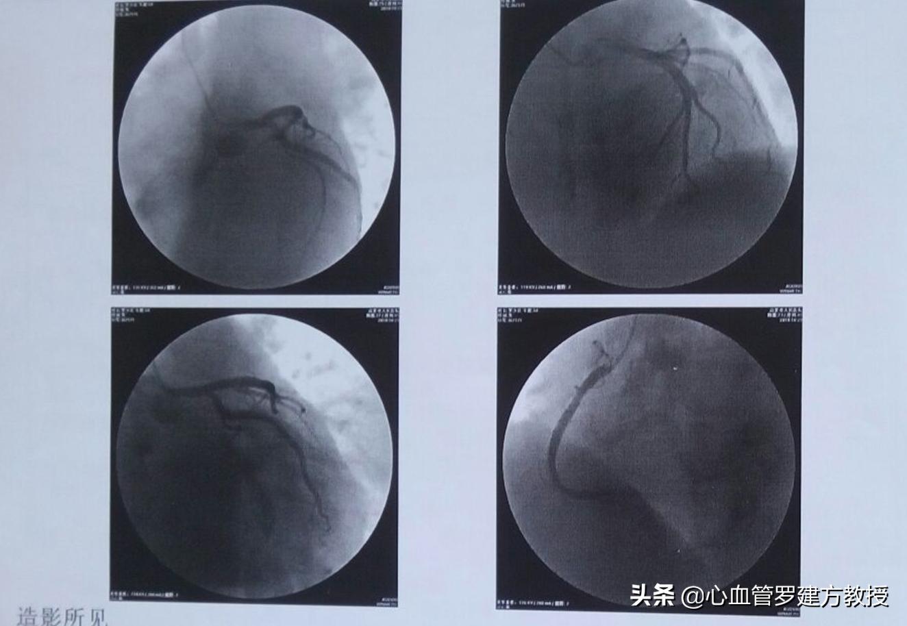 冠脉左前降支60-70狭窄要做支架吗,冠脉狭窄20%需要治疗吗