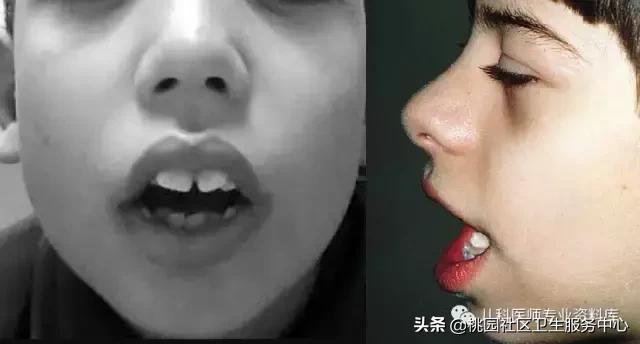 过敏性鼻炎手术的全过程,治疗过敏性鼻炎有效的药