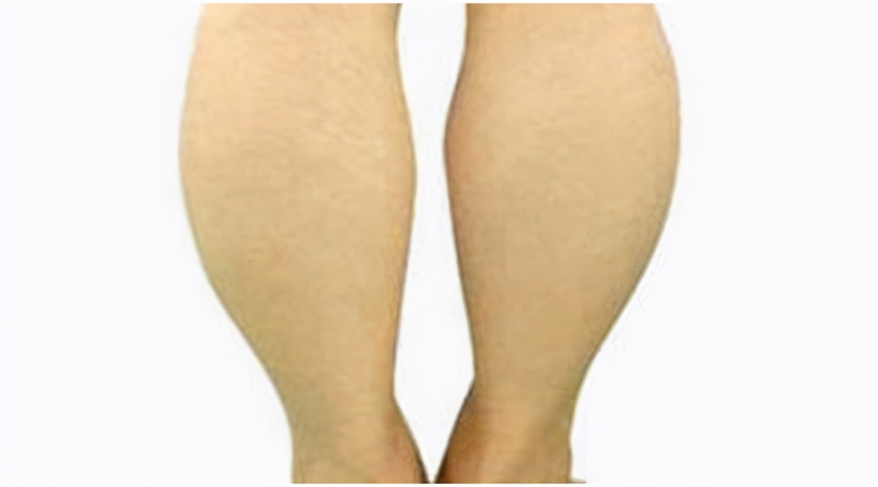 大小腿吸脂半个月小腿一碰就痛,小腿吸脂可以瘦几厘米