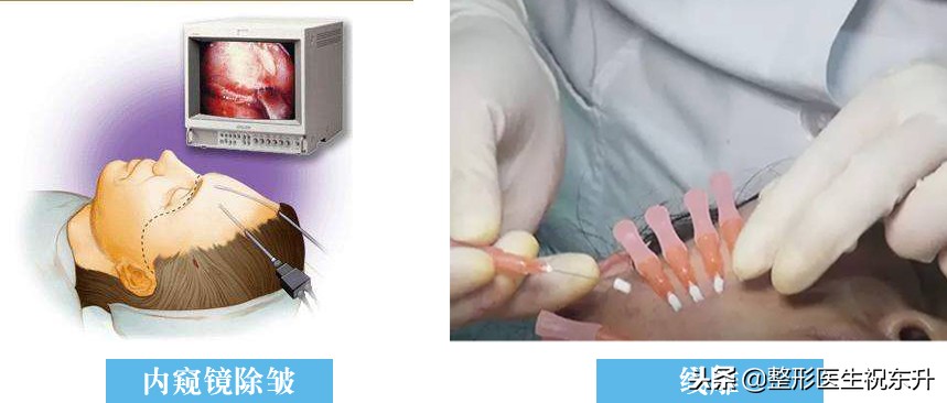 线雕除皱什么意思,线雕除皱可以同时做吗