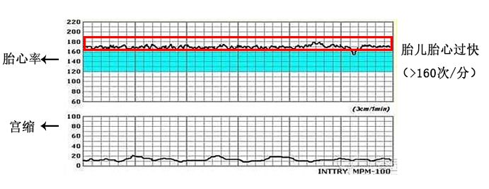 怎么能顺利快速通过胎心监护,怎么使胎心监护快速过关