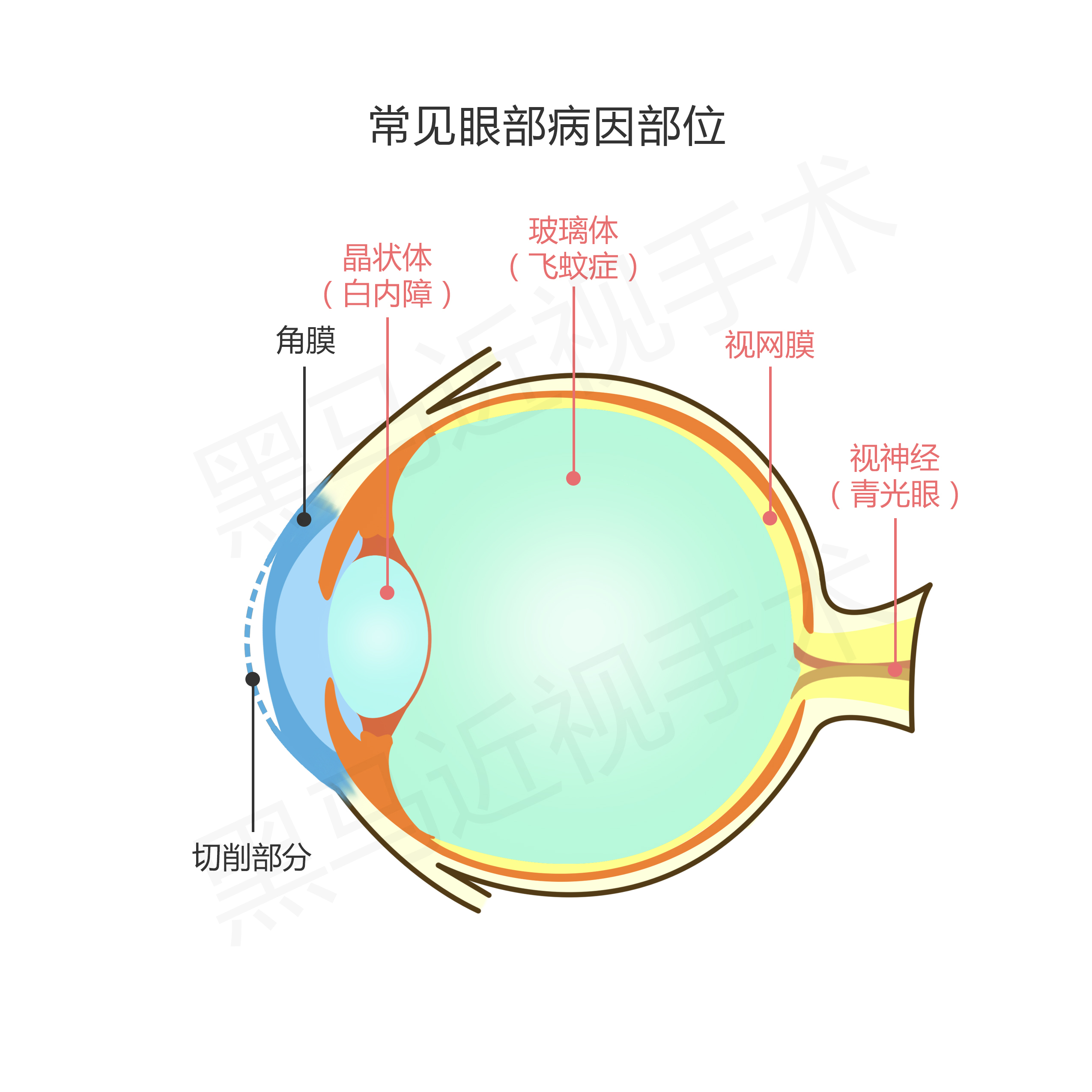 激光近视矫正手术有什么后遗症,激光治疗近视安全啊有没有后遗症